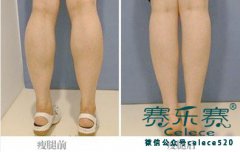 瘦小腿的好方法 让你夏季就敢露